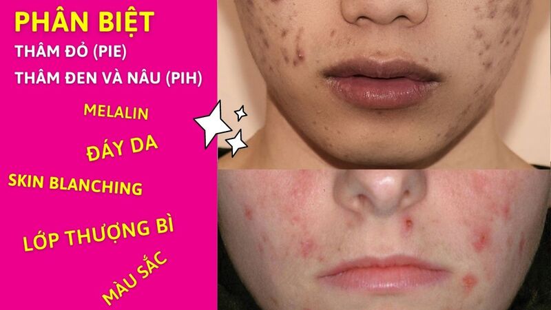 Bảng giá dịch vụ trị thâm mụn ở spa giá bao nhiêu 2022? phân biệt thâm mụn và thâm sẹo