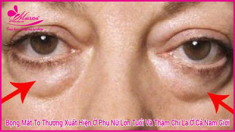 Người có bọng mắt to đẹp hay xấu? tướng số có tốt không? người có bọng mắt đẹp hay xấu