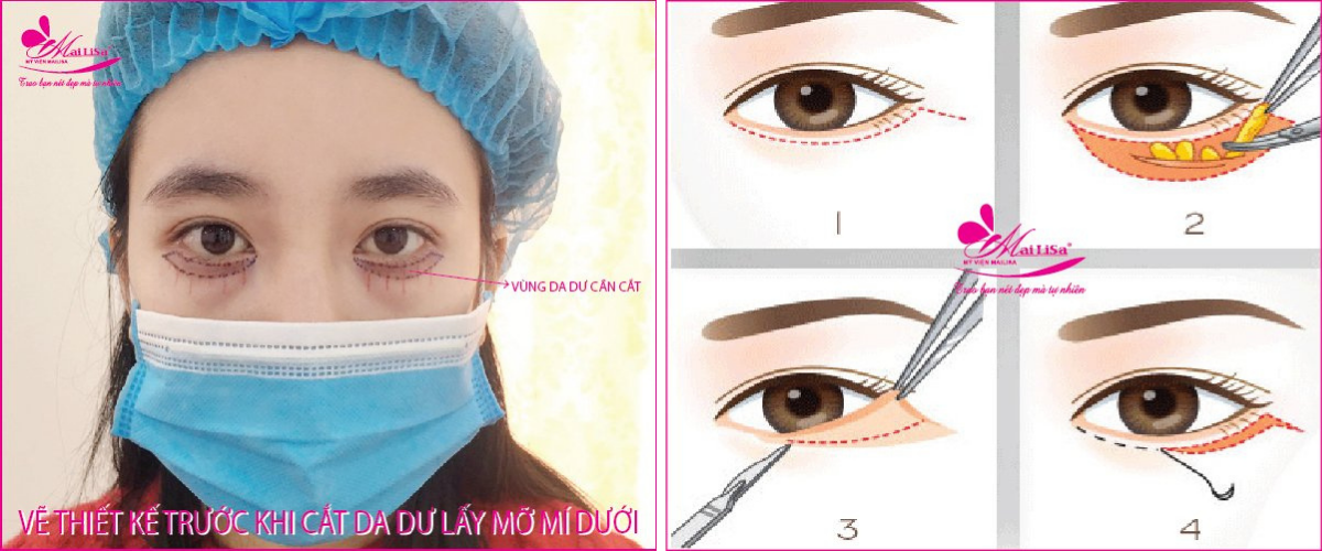 Cắt da dư lấy mỡ mí dưới Cắt da dư lấy mỡ mí dưới