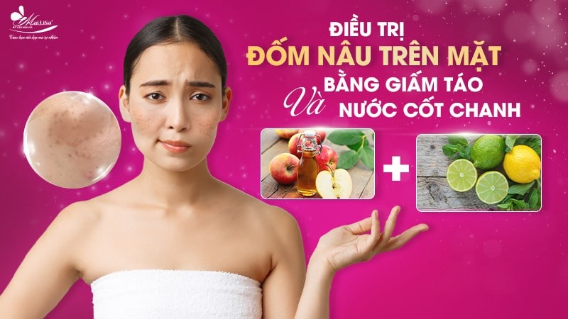 8 Cách trị đốm nâu trên mặt thịnh hành hiện nay 7 - 7 đốm nâu trên mặt thuoc tri tan nhang dom nau