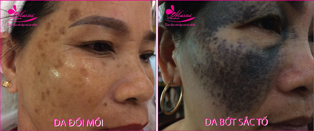 Làm đẹp da nám bằng công nghệ cao Làm đẹp da nám bằng công nghệ cao