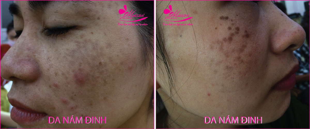 Làm đẹp da nám bằng công nghệ cao Làm đẹp da nám bằng công nghệ cao