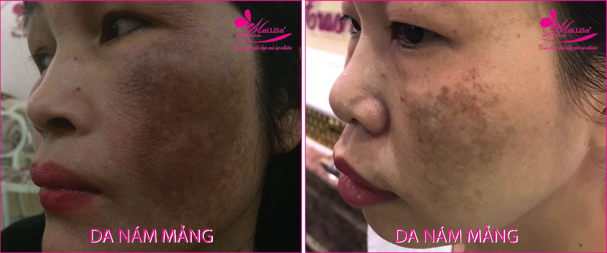 Làm đẹp da nám bằng công nghệ cao Làm đẹp da nám bằng công nghệ cao