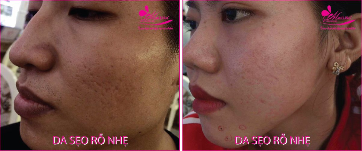 Làm đẹp da sẹo rỗ bằng công nghệ cao Làm đẹp da sẹo rỗ bằng công nghệ cao