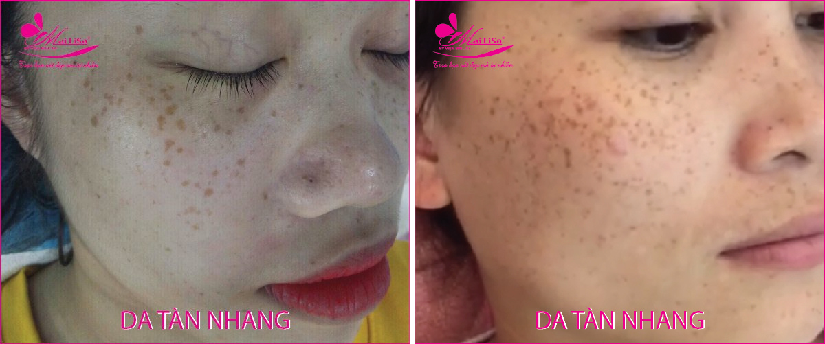 Làm đẹp da nám bằng công nghệ cao Làm đẹp da nám bằng công nghệ cao