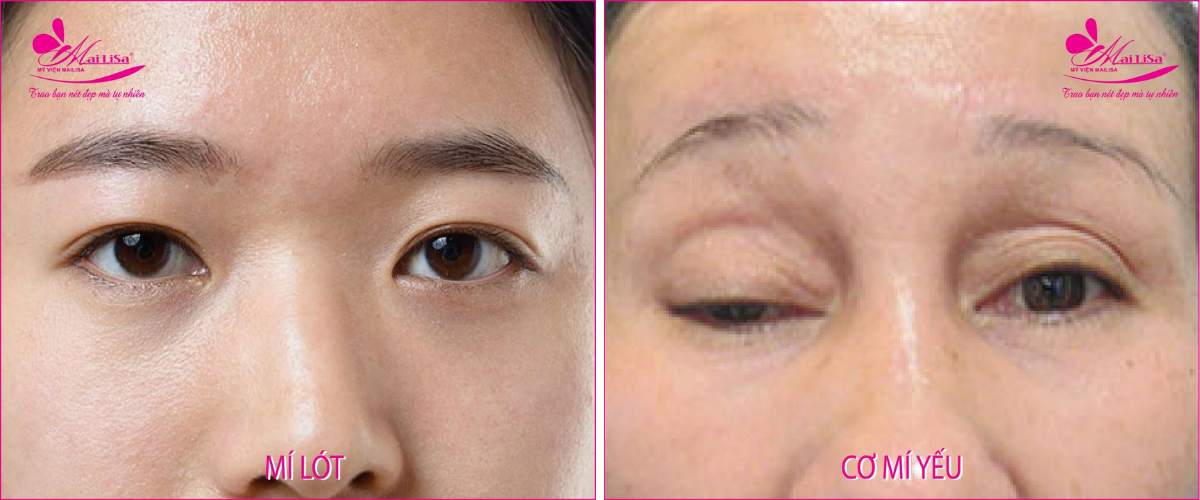 Dịch vụ cắt mắt 2 mí Dịch vụ cắt mắt 2 mí