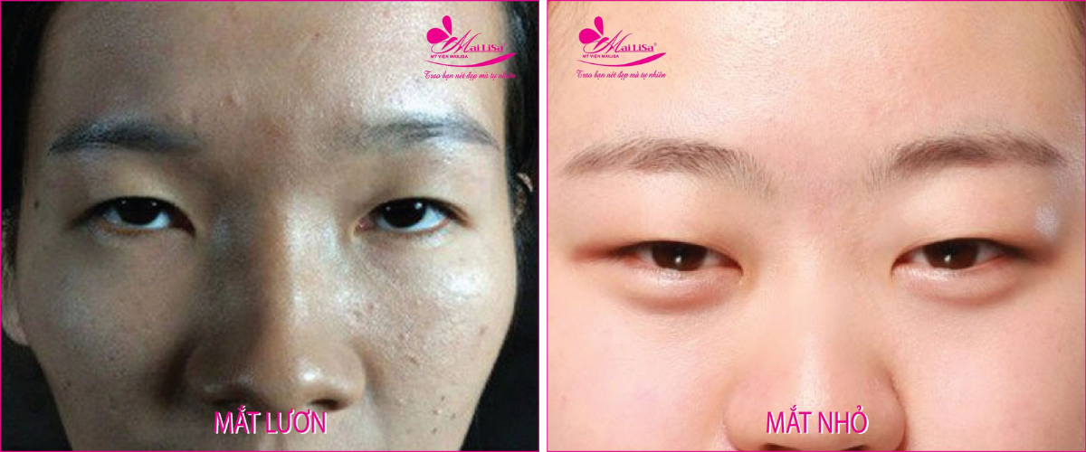 Dịch vụ cắt mắt 2 mí Dịch vụ cắt mắt 2 mí