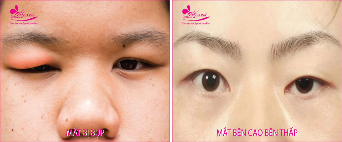 Dịch vụ cắt mắt 2 mí Dịch vụ cắt mắt 2 mí