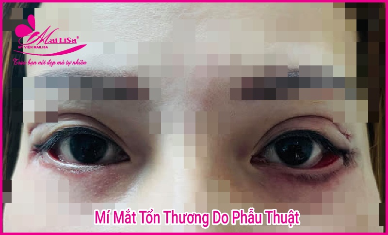 Phẫu thuật nâng cơ mí mắt là gì? Giá bao nhiêu HỢP LÝ 2023? Tổn thương do phẫu thuật