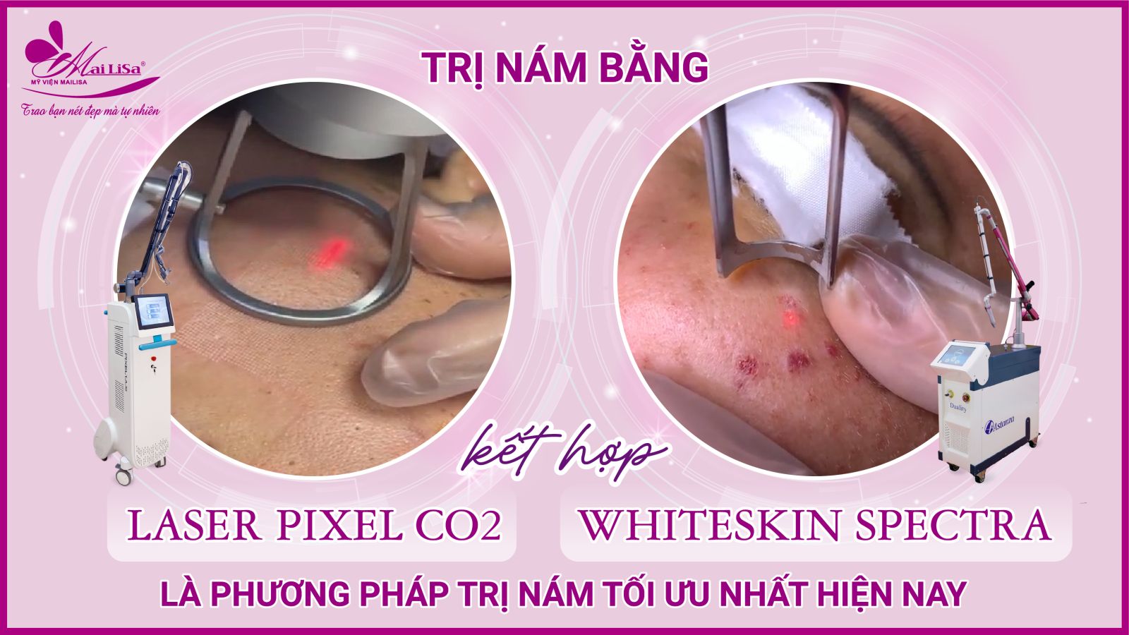 Bắn laser trị nám Whiteskin spectra có tốt không? Chi phí 2023 Bắn laser trị nám Whiteskin spectra có tốt không? Chi phí 2023