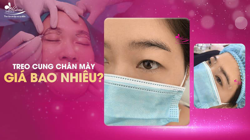 Treo chân mày là gì và có những phương pháp nào năm 2024 19 - 19 treo chân mày treo cung chan may