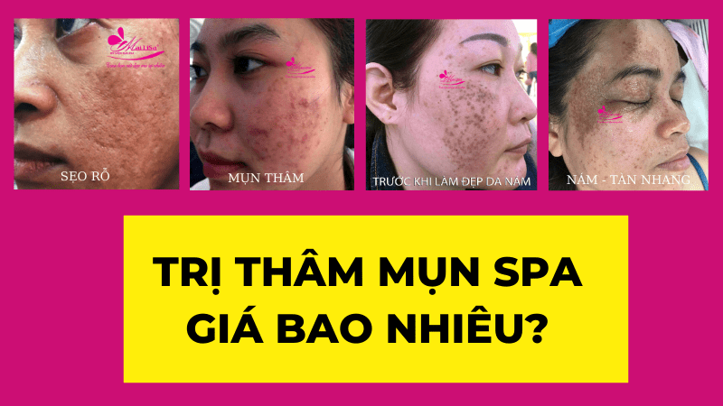 Bảng giá dịch vụ trị thâm mụn ở spa giá bao nhiêu 2022? tri-tham-mun-spa-gia-bao-nhieu