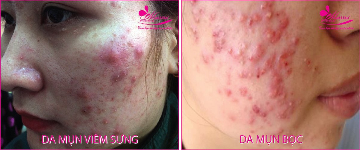 Làm đẹp da mụn thâm bằng công nghệ cao Làm đẹp da mụn thâm bằng công nghệ cao