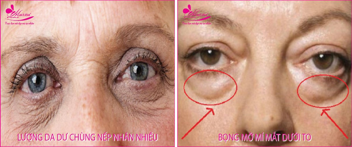 Cắt da dư lấy mỡ mí dưới Cắt da dư lấy mỡ mí dưới