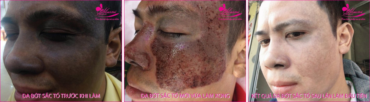 Làm đẹp da nám bằng công nghệ cao Làm đẹp da nám bằng công nghệ cao