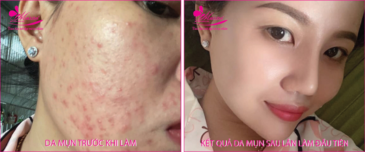 Làm đẹp da mụn thâm bằng công nghệ cao Làm đẹp da mụn thâm bằng công nghệ cao