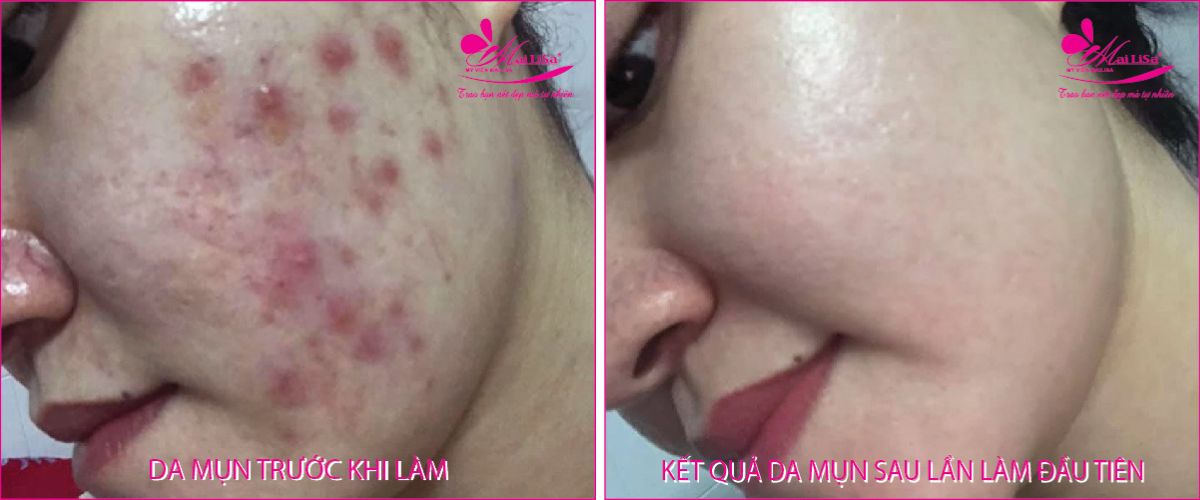Làm đẹp da mụn thâm bằng công nghệ cao Làm đẹp da mụn thâm bằng công nghệ cao