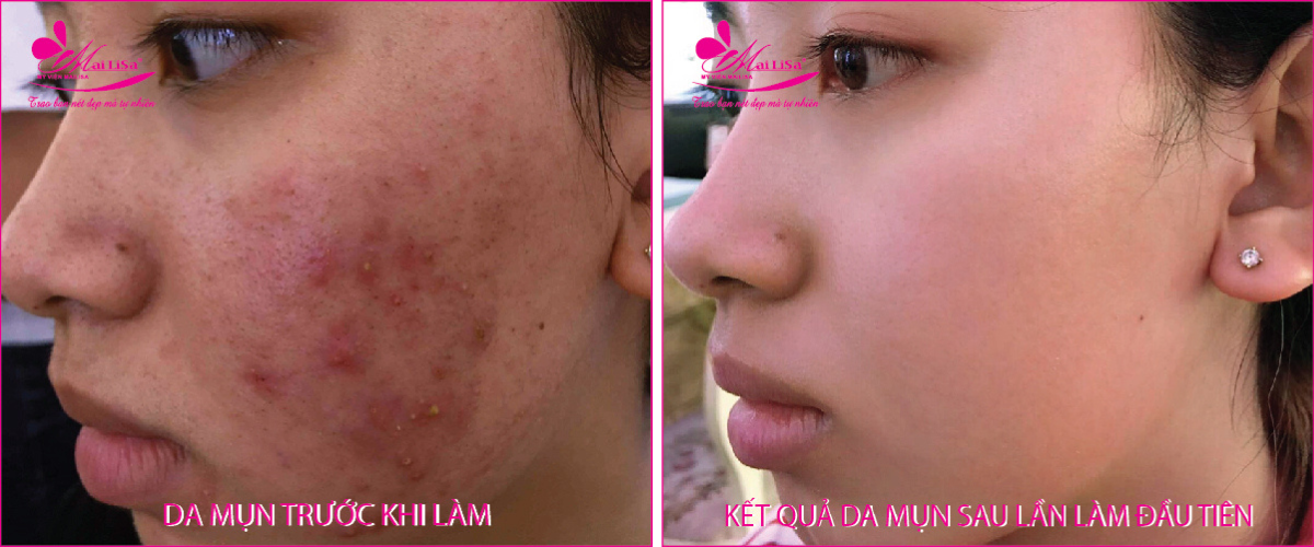Làm đẹp da mụn thâm bằng công nghệ cao Làm đẹp da mụn thâm bằng công nghệ cao