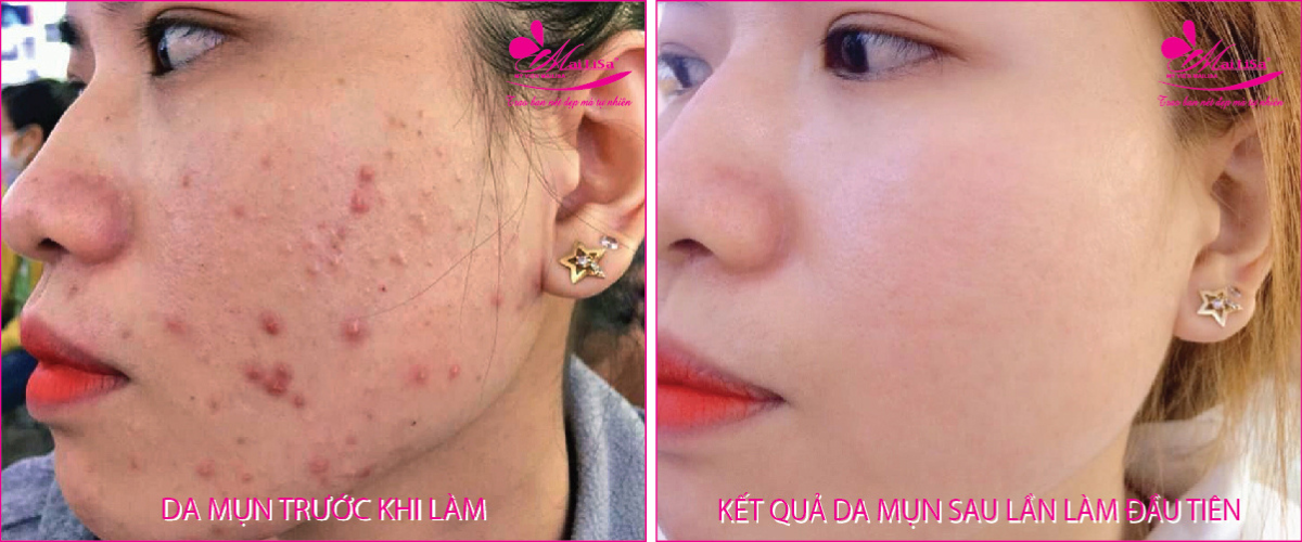 Làm đẹp da mụn thâm bằng công nghệ cao Làm đẹp da mụn thâm bằng công nghệ cao