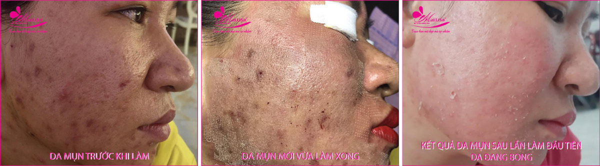Làm đẹp da mụn thâm bằng công nghệ cao Làm đẹp da mụn thâm bằng công nghệ cao