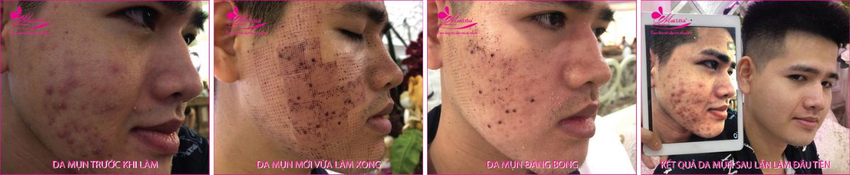 Làm đẹp da mụn thâm bằng công nghệ cao Làm đẹp da mụn thâm bằng công nghệ cao