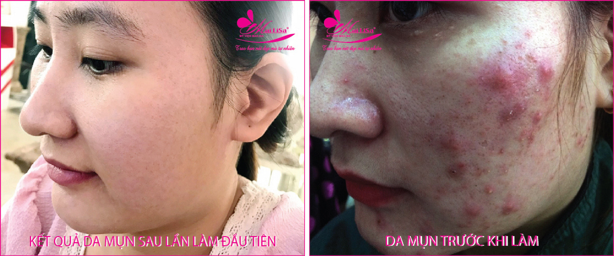 Làm đẹp da mụn thâm bằng công nghệ cao Làm đẹp da mụn thâm bằng công nghệ cao