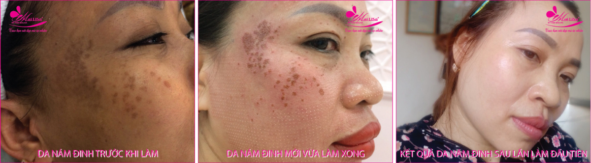 Làm đẹp da nám bằng công nghệ cao Làm đẹp da nám bằng công nghệ cao