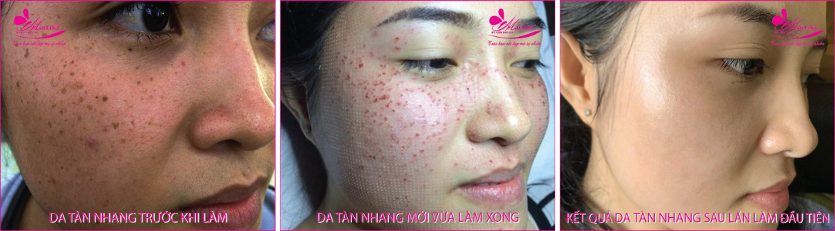 Làm đẹp da nám bằng công nghệ cao Làm đẹp da nám bằng công nghệ cao