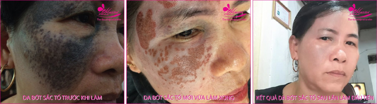 Làm đẹp da nám bằng công nghệ cao Làm đẹp da nám bằng công nghệ cao