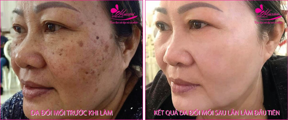 Làm đẹp da nám bằng công nghệ cao Làm đẹp da nám bằng công nghệ cao