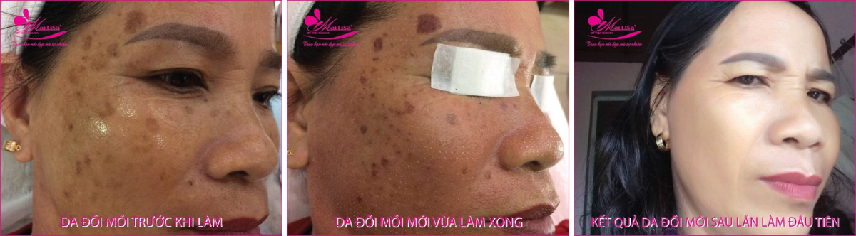 Làm đẹp da nám bằng công nghệ cao Làm đẹp da nám bằng công nghệ cao