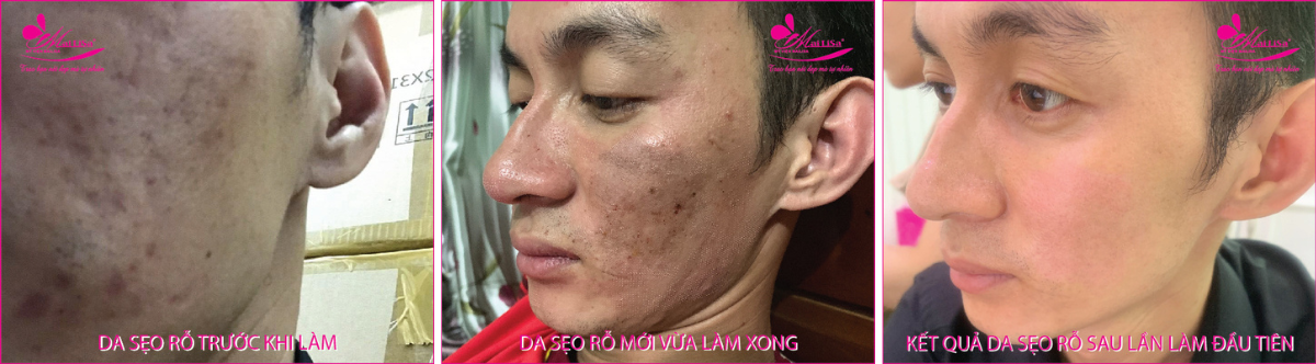 Làm đẹp da sẹo rỗ bằng công nghệ cao Làm đẹp da sẹo rỗ bằng công nghệ cao