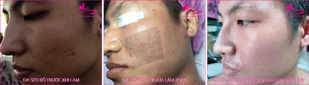 Làm đẹp da sẹo rỗ bằng công nghệ cao Làm đẹp da sẹo rỗ bằng công nghệ cao