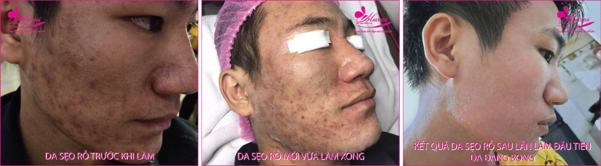 Làm đẹp da sẹo rỗ bằng công nghệ cao Làm đẹp da sẹo rỗ bằng công nghệ cao