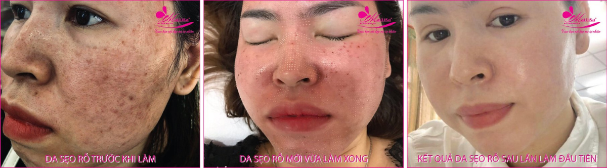 Làm đẹp da sẹo rỗ bằng công nghệ cao Làm đẹp da sẹo rỗ bằng công nghệ cao