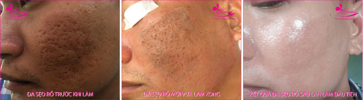 Làm đẹp da sẹo rỗ bằng công nghệ cao Làm đẹp da sẹo rỗ bằng công nghệ cao