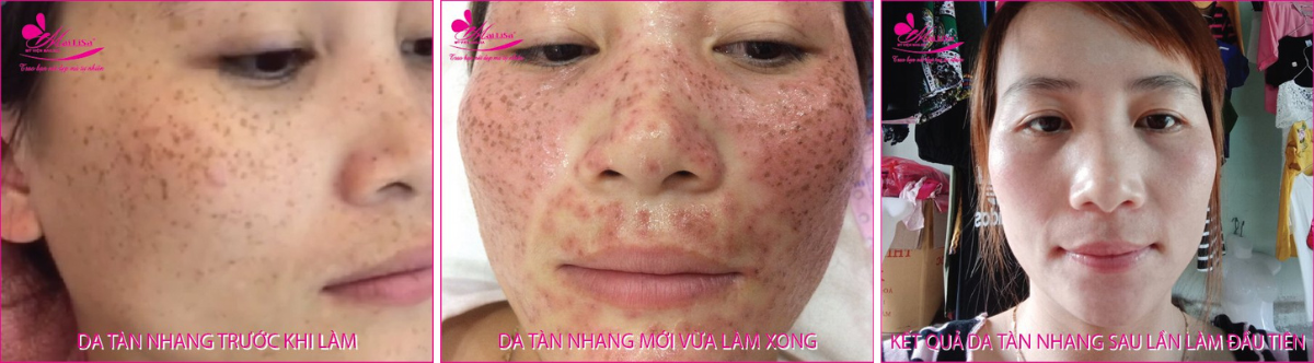 Làm đẹp da nám bằng công nghệ cao Làm đẹp da nám bằng công nghệ cao