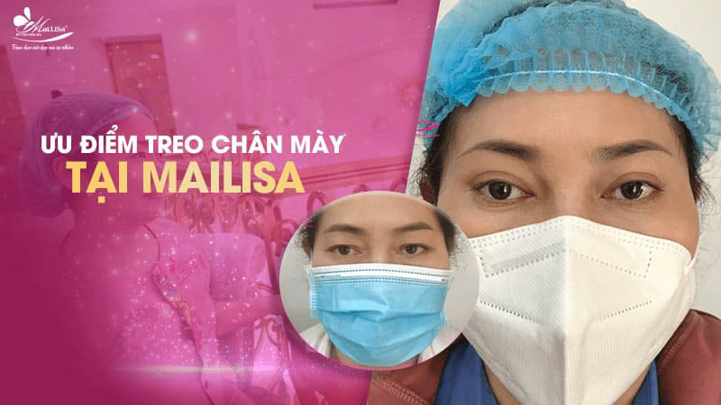 Treo chân mày là gì và có những phương pháp nào năm 2024 18 - 18 treo chân mày uu diem treo chan may tai mailisa