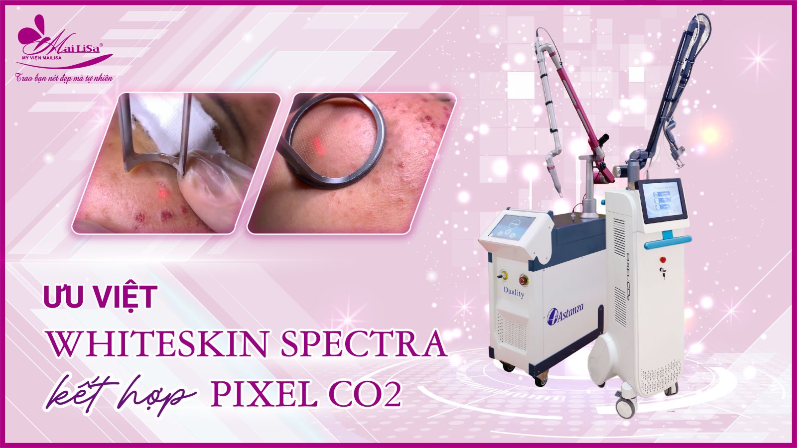 Bắn laser trị nám Whiteskin spectra có tốt không? Chi phí 2023 Bắn laser trị nám Whiteskin spectra có tốt không? Chi phí 2023