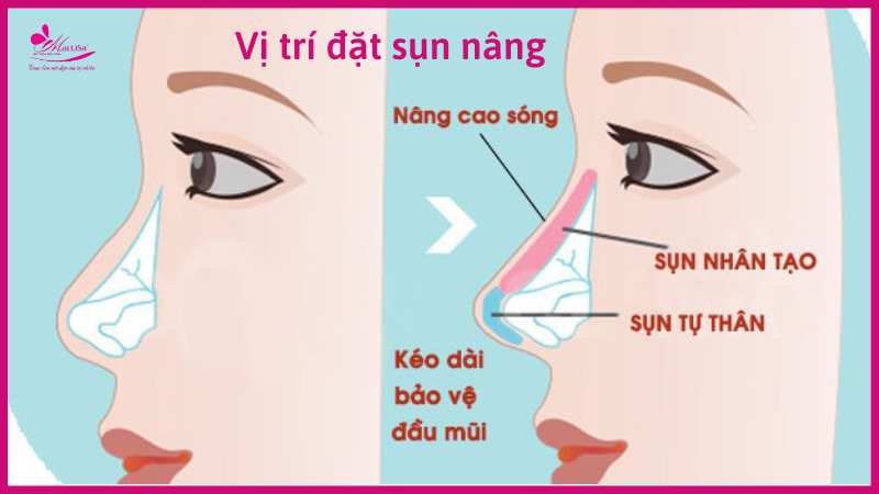 Bị viêm xoang có nâng mũi được không, có nguy hiểm không ? vị trí đặt sụn nâng