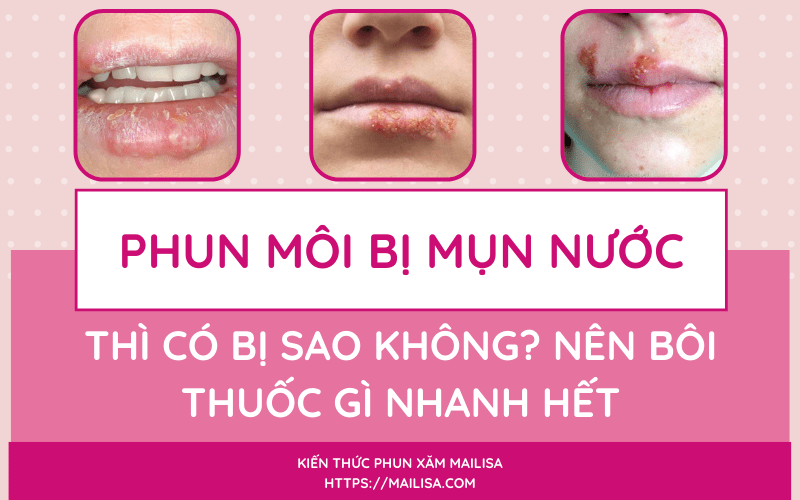 Mụn nước ở môi sau khi phun xăm có nguy hiểm không? Nên uống thuốc gì? chữa mụn nước ở môi nên bôi thuốc gì