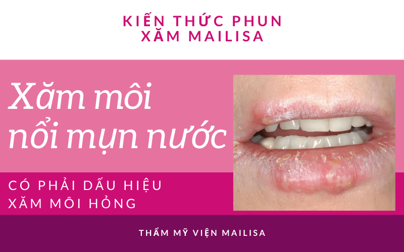 Mụn nước ở môi sau khi phun xăm có nguy hiểm không? Nên uống thuốc gì? phun xăm môi bị mụn nước có phải xăm môi bị hỏng