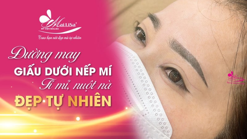 Có nên lấy mỡ mí mắt nội soi không và những điều cần tránh 9 - 9 lấy mỡ mí mắt nội soi lấy mỡ mí mắt nội soi