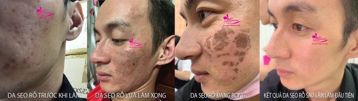Làm đẹp da sẹo rỗ bằng công nghệ cao Làm đẹp da sẹo rỗ bằng công nghệ cao