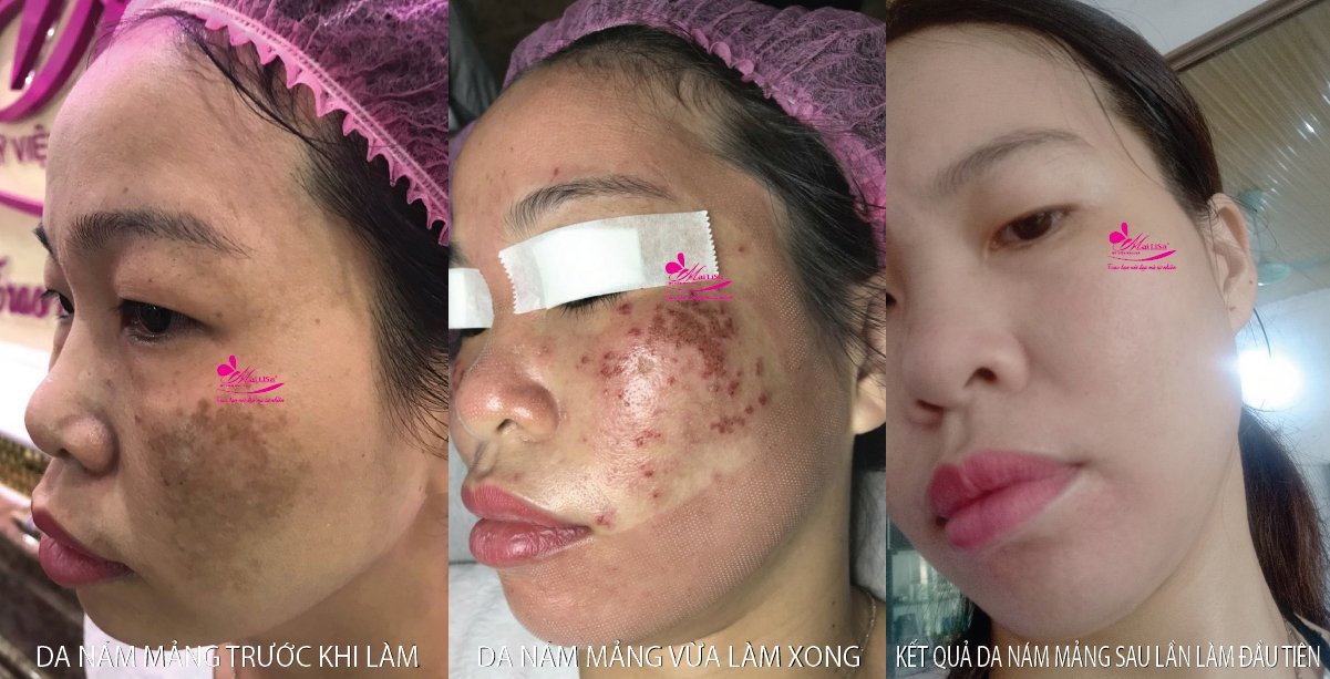 Làm đẹp da nám bằng công nghệ cao Làm đẹp da nám bằng công nghệ cao