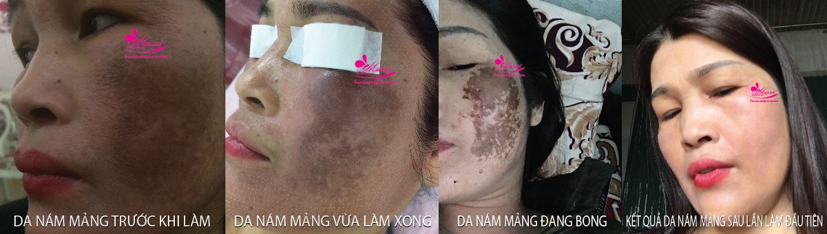 Làm đẹp da nám bằng công nghệ cao Làm đẹp da nám bằng công nghệ cao