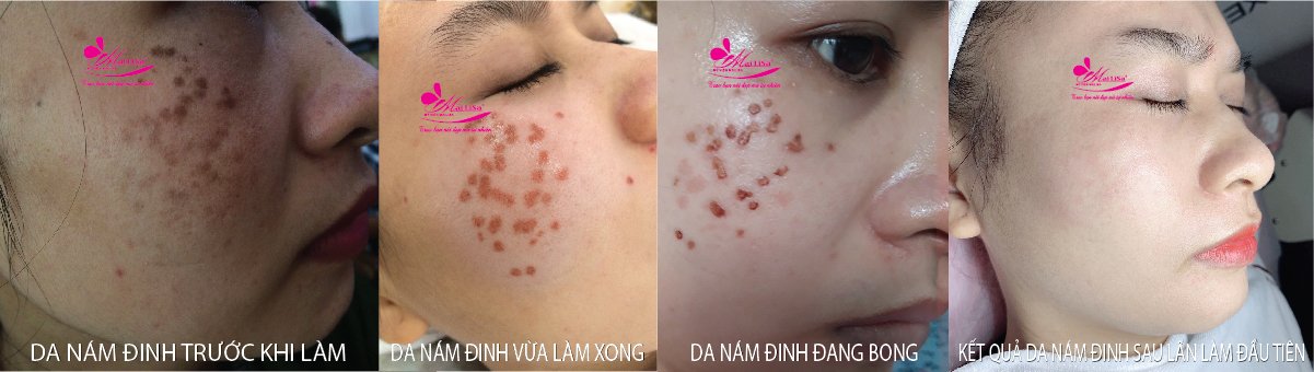 Làm đẹp da nám bằng công nghệ cao Làm đẹp da nám bằng công nghệ cao