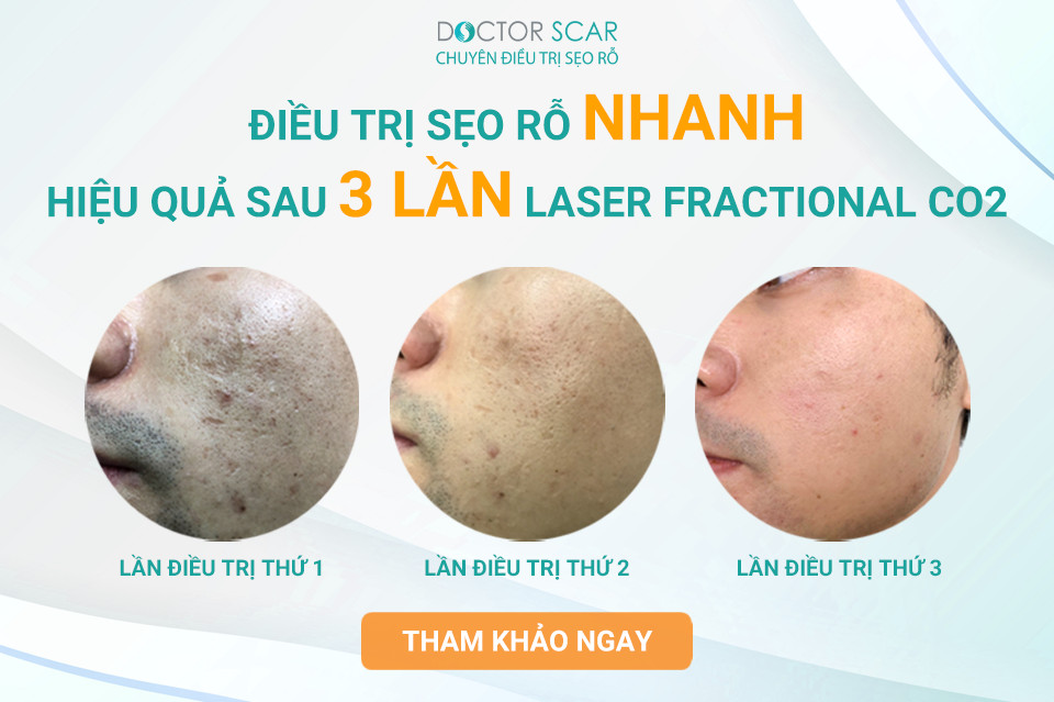 ads-laser-co2
