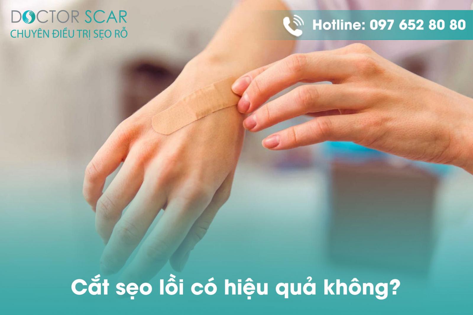 cat-seo-loi-co-hieu-qua-khong Cắt sẹo lồi có hiệu quả không?