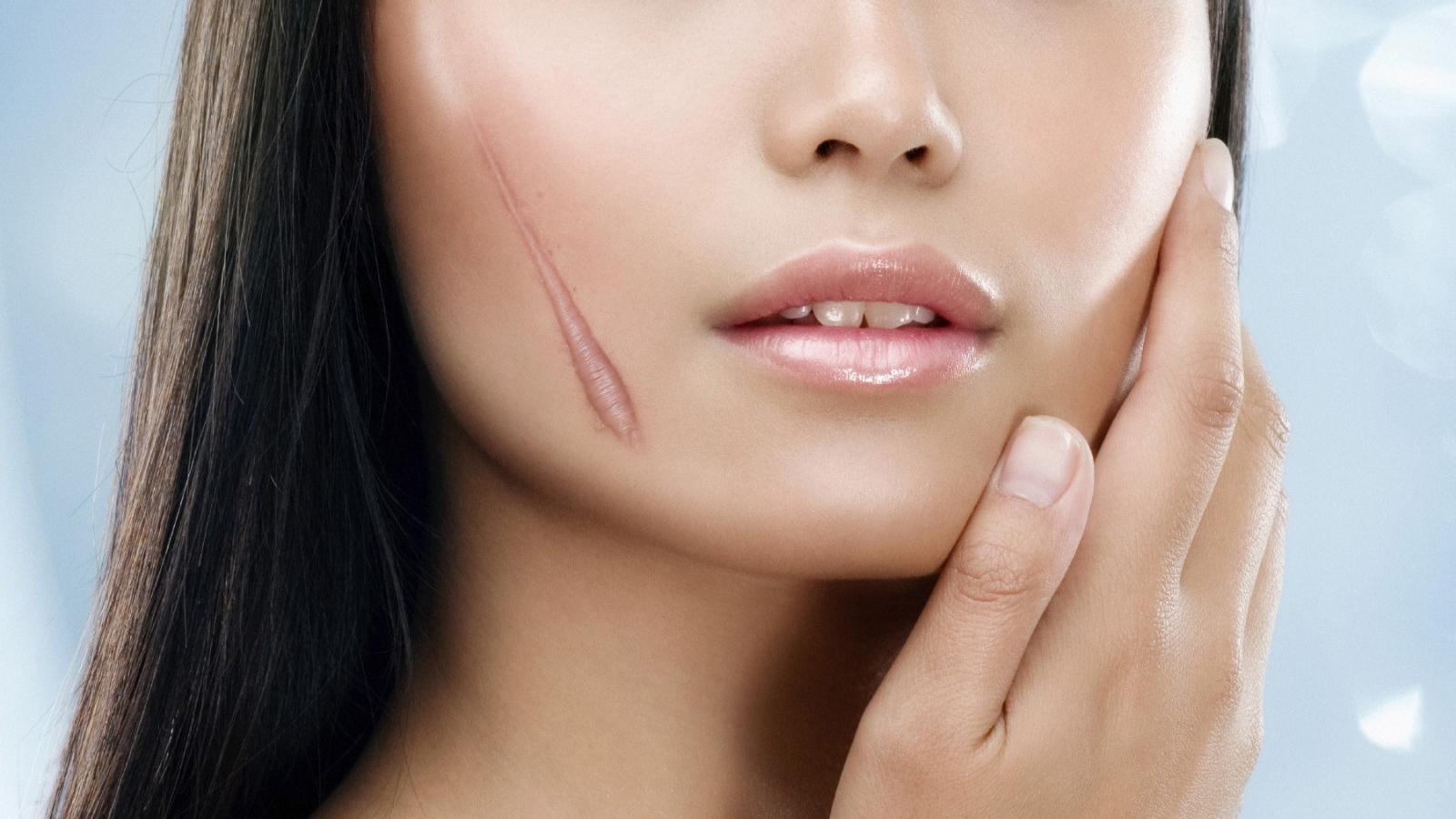 image26 trị sẹo lồi giá bao nhiêu